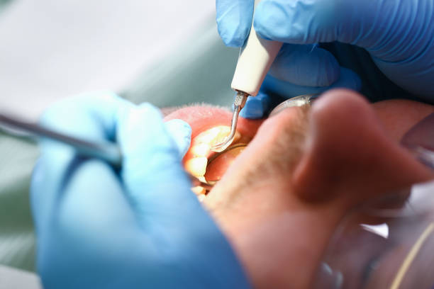 Best Emergency Broken Tooth Repair in Ponchatou, LA