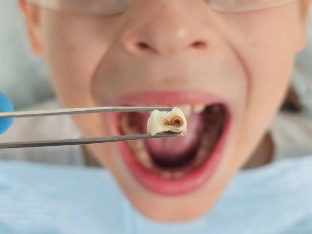 Best Emergency Treatment for Toothache in Ponchatou, LA